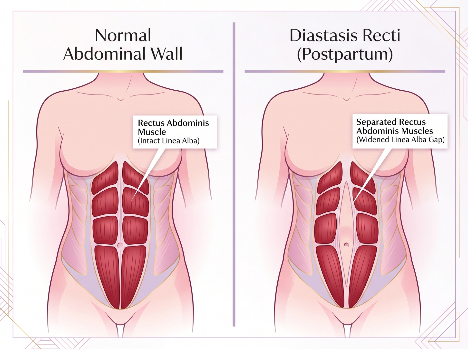 Medical illustration comparing normal abdominal wall with intact linea alba versus diastasis recti with widened linea alba gap postpartum